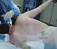 تشريح الكتف وعملية إيدن لانج