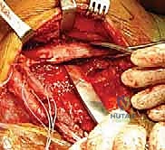 نقل العضلات المعينية