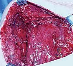 تثبيت العضلة الرافعة للكتف