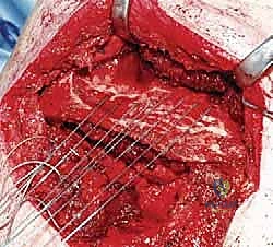 تفاصيل نقل العضلات في الجراحة