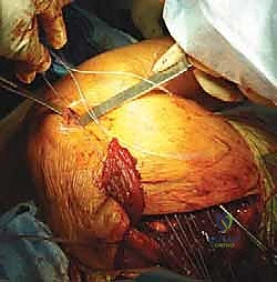 إغلاق الجرح والنتيجة النهائية