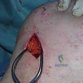 عملية إيدن لانج: حل جراحي متقدم لشلل العضلة شبه المنحرفة وتثبيت الكتف