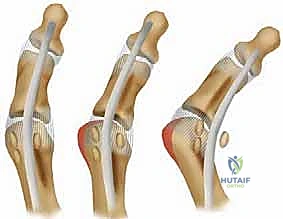 الأعراض السريرية لكسر العظم السمسمي