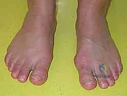 أسباب كسور إبهام القدم الرياضية