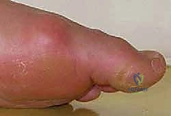 تأثير الإجهاد المتكرر على العظام السمسمية