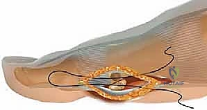 صورة توضيحية لـ كسور العظم السمسمي لإبهام القدم: دليل شامل للتثبيت الداخلي الدقيق مع الأستاذ الدكتور محمد هطيف