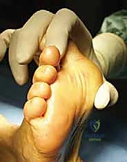 صورة توضيحية لـ كسور العظم السمسمي لإبهام القدم: دليل شامل للتثبيت الداخلي الدقيق مع الأستاذ الدكتور محمد هطيف