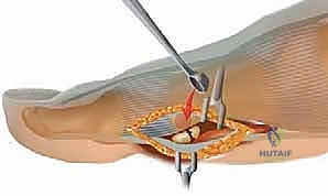 خيارات العلاج التحفظي والجراحي