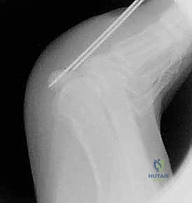 صورة توضيحية لـ كسور العظم السمسمي لإبهام القدم: دليل شامل للتثبيت الداخلي الدقيق مع الأستاذ الدكتور محمد هطيف