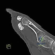 Masterclass: Precision Internal Fixation of Hallux Sesamoid Fractures