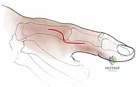 صورة توضيحية لـ إعادة بناء أربطة مفصل إبهام اليد: دليل شامل للمرضى في صنعاء مع الأستاذ الدكتور محمد هطيف