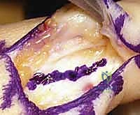 التشريح الدقيق لمفصل إبهام اليد والأربطة الجانبية