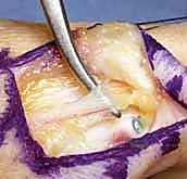 إعادة بناء أربطة مفصل إبهام اليد: دليل شامل للمرضى في صنعاء مع الأستاذ الدكتور محمد هطيف