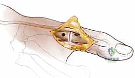 صورة طبية: إعادة بناء أربطة مفصل إبهام اليد: دليل شامل للمرضى في صنعاء مع الأستاذ الدكتور محمد هطيف