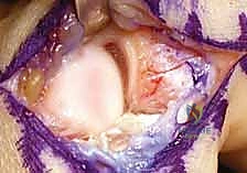 تمزق الرباط الجانبي الزندي وإصابة المتزلج