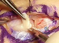 توضيح العظام المكونة لمفصل الإبهام الرسغي السلامي