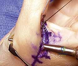 آلية حدوث عدم استقرار مفصل الإبهام