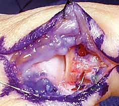 صورة طبية: إعادة بناء أربطة مفصل إبهام اليد: دليل شامل للمرضى في صنعاء مع الأستاذ الدكتور محمد هطيف