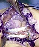 صورة طبية: إعادة بناء أربطة مفصل إبهام اليد: دليل شامل للمرضى في صنعاء مع الأستاذ الدكتور محمد هطيف