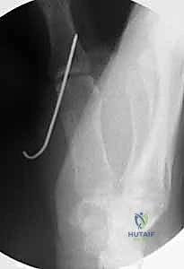 صورة توضيحية لـ إعادة بناء أربطة مفصل إبهام اليد: دليل شامل للمرضى في صنعاء مع الأستاذ الدكتور محمد هطيف