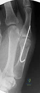 صورة طبية: إعادة بناء أربطة مفصل إبهام اليد: دليل شامل للمرضى في صنعاء مع الأستاذ الدكتور محمد هطيف