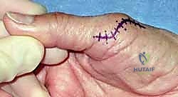 صورة توضيحية لـ إعادة بناء أربطة مفصل إبهام اليد: دليل شامل للمرضى في صنعاء مع الأستاذ الدكتور محمد هطيف