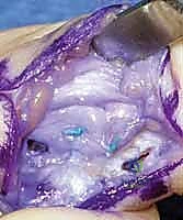 صورة طبية: إعادة بناء أربطة مفصل إبهام اليد: دليل شامل للمرضى في صنعاء مع الأستاذ الدكتور محمد هطيف