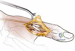 صورة طبية: إعادة بناء أربطة مفصل إبهام اليد: دليل شامل للمرضى في صنعاء مع الأستاذ الدكتور محمد هطيف