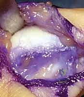 صورة طبية: إعادة بناء أربطة مفصل إبهام اليد: دليل شامل للمرضى في صنعاء مع الأستاذ الدكتور محمد هطيف