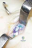 صورة طبية: إعادة بناء أربطة مفصل إبهام اليد: دليل شامل للمرضى في صنعاء مع الأستاذ الدكتور محمد هطيف