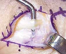 صورة طبية: إعادة بناء أربطة مفصل إبهام اليد: دليل شامل للمرضى في صنعاء مع الأستاذ الدكتور محمد هطيف