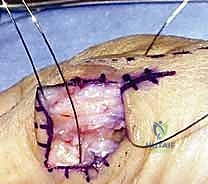 صورة طبية: إعادة بناء أربطة مفصل إبهام اليد: دليل شامل للمرضى في صنعاء مع الأستاذ الدكتور محمد هطيف