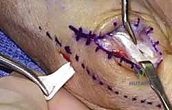 صورة توضيحية لـ إعادة بناء أربطة مفصل إبهام اليد: دليل شامل للمرضى في صنعاء مع الأستاذ الدكتور محمد هطيف