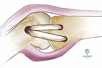 صورة طبية: إعادة بناء أربطة مفصل إبهام اليد: دليل شامل للمرضى في صنعاء مع الأستاذ الدكتور محمد هطيف