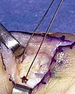 صورة طبية: إعادة بناء أربطة مفصل إبهام اليد: دليل شامل للمرضى في صنعاء مع الأستاذ الدكتور محمد هطيف