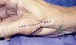 Intraoperative Surgical Step