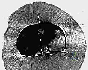 تركيب المفصل الصناعي الجديد المخصص لحالات المراجعة