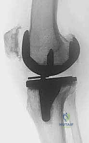 صورة توضيحية لـ جراحة مراجعة مفصل الركبة المتصلب علاج شامل لاستعادة الحركة في صنعاء مع الأستاذ الدكتور محمد هطيف