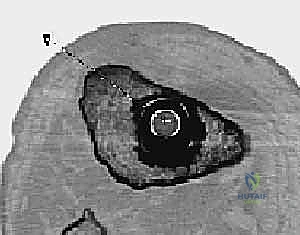 صورة توضيحية لـ جراحة مراجعة مفصل الركبة المتصلب علاج شامل لاستعادة الحركة في صنعاء مع الأستاذ الدكتور محمد هطيف
