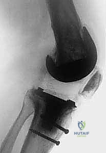 صورة توضيحية لـ جراحة مراجعة مفصل الركبة المتصلب علاج شامل لاستعادة الحركة في صنعاء مع الأستاذ الدكتور محمد هطيف