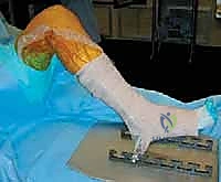 صورة توضيحية لـ جراحة مراجعة مفصل الركبة المتصلب علاج شامل لاستعادة الحركة في صنعاء مع الأستاذ الدكتور محمد هطيف