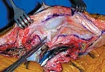 جراحة مراجعة مفصل الركبة المتصلب علاج شامل لاستعادة الحركة في صنعاء مع الأستاذ الدكتور محمد هطيف