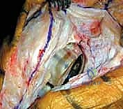 استئصال الأنسجة الندبية الكثيفة وتحرير الكبسولة المفصلية