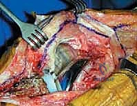 الأستاذ الدكتور محمد هطيف أثناء إجراء إحدى الجراحات المعقدة