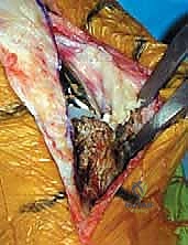 إعادة ضبط توازن الأربطة والفجوات الميكانيكية للمفصل