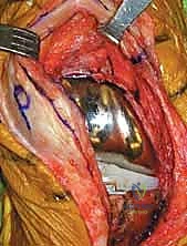 التخطيط الجراحي الدقيق لمراجعة مفصل الركبة مع الأستاذ الدكتور محمد هطيف