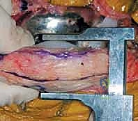 تشريح مفصل الركبة وتكون الأنسجة الندبية المسببة للتصلب