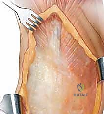 تقييم الأسباب الميكانيكية والجراحية لتصلب مفصل الركبة