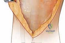 الفحص السريري الدقيق لمدى حركة الركبة والتيبس المفصلي