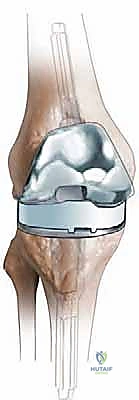 تشخيص تصلب الركبة باستخدام الأشعة السينية والمقطعية